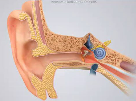 Perforated Ear Drum