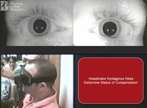 VIDEO: Headshake Nystagmus Helps Determine Status of Compensation - The ...