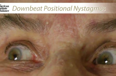 VIDEO: Cardiogenic vs. CNS Downbeat Nystagmus (DBN)